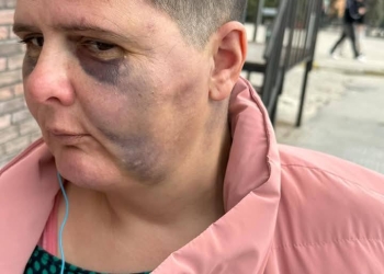 E rëndë: Publikohen fotot e një gruaja të dhunuar fizikisht, dyshohet se ajo përdoret edhe seksualisht