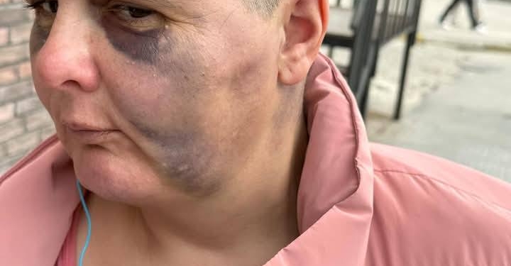 E rëndë: Publikohen fotot e një gruaja të dhunuar fizikisht, dyshohet se ajo përdoret edhe seksualisht