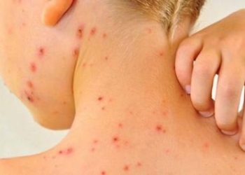 Fruthi shpërndahet në Kosovë, mosvaksinimi po e rrit numrin nga viti në vit