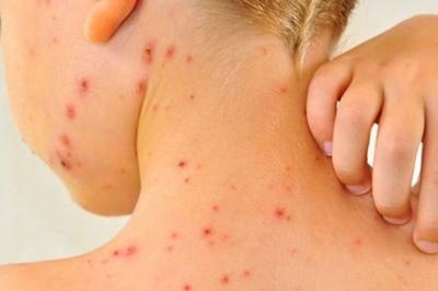 Fruthi shpërndahet në Kosovë, mosvaksinimi po e rrit numrin nga viti në vit