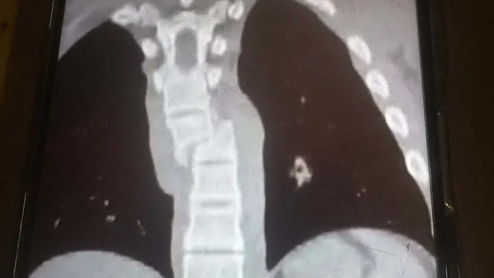 I riu nga Lipjani aksidentohet rëndë me motor – kërkohet ndihmë urgjente për t’i mbuluar shpenzimet mjekësore